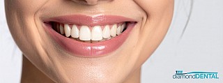 How Dentists Customize Veneers to Your Smile