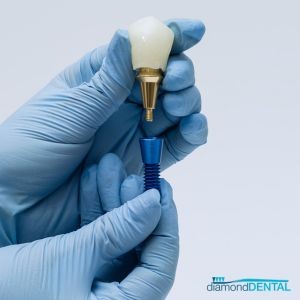 How Dental Implants Help Preserve Bone Health