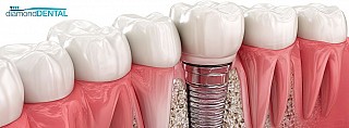 Comparing Dental Implants with Bridges and Dentures