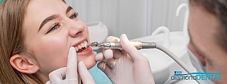 Tips for Booking a Teeth Cleaning when You Have Dental Anxiety