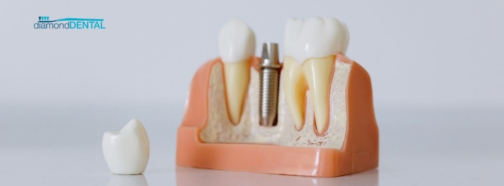 dental implants investment dentist Vaughan