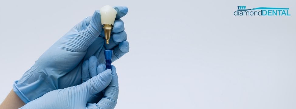 dental implants vaughan dental implants vaughan