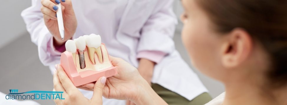 dental implants vaughan dental implants vaughan